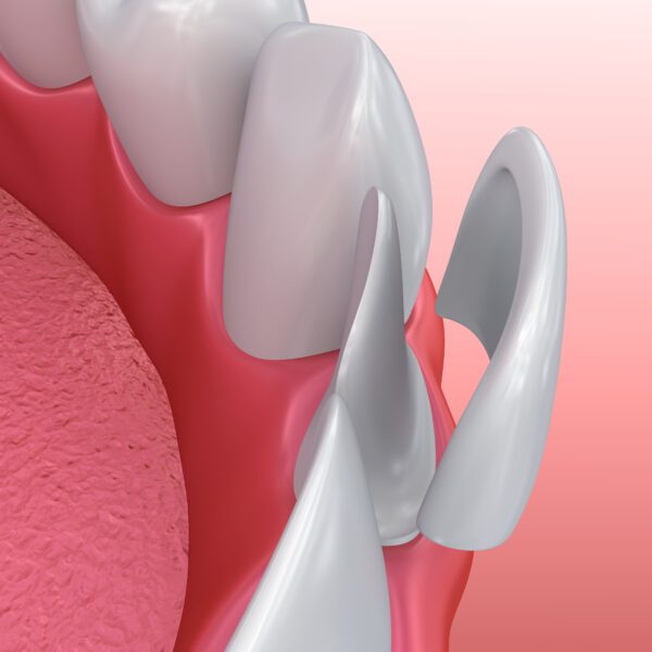 Dental Veneers: Porcelain Veneer installation Procedure. 3D illu